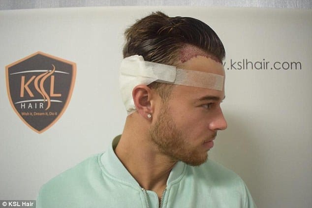 Ouch! Meanwhile back in the UK, her ex-boyfriend Alex Beattie got a hair transplant after admitting he had been 'extremely insecure' about his hairline for 'years'
